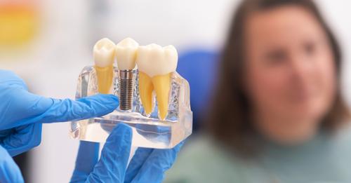 Choosing-the-Best-Tooth-Implants-in-Turlock-CA.jpg