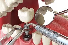 Choosing-the-Best-Tooth-Implants-in-Turlock-CA.jpg