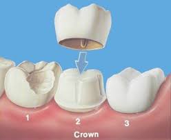 Dental-Crowns-Warwick-In-NY.jpg