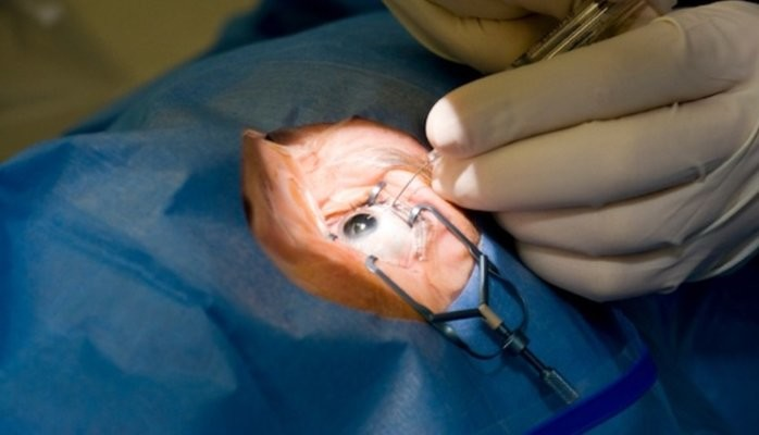 Achieve Clear Vision with Laser Treatment for Eyes in Brisbane and Pterygium Surgery