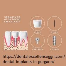 Dental-Implants-in-gurgaon.jpg