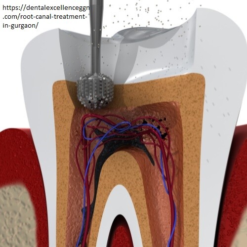 root-canal-treatment12.jpg